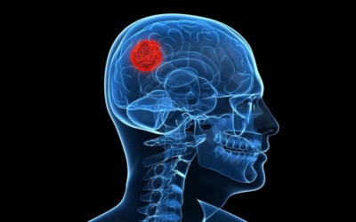 Симптомы и причины появления опухоли головного мозга. Сколько с ней живут и есть ли шанс вылечить болезнь?