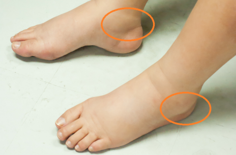 Растяжение связок I степени внутренней лодыжки на левой, и наружной лодыжки на правой ноге.