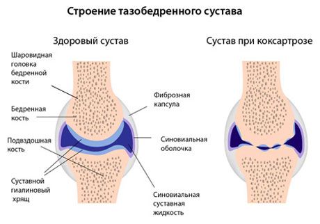 Различия анатомии сустава при коксартрозе