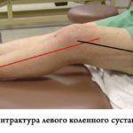 Разработка конечности поможет улучшить состояние колена при контрактуре.