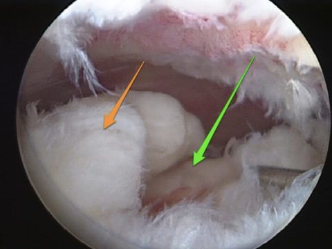 Разрыв связок в процессе травмирования колена.