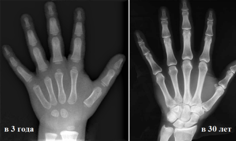 Рентген кисти и ее сочленения с костями предплечья