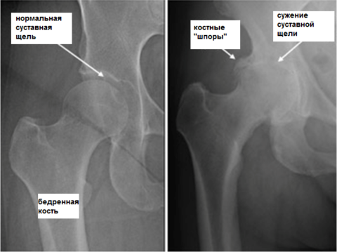 Рентген костей таза помогает подтвердить специалисту правильность поставленного диагноза.