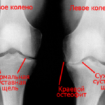 Рентген наиболее часто применяют для диагностики гонартроза коленей