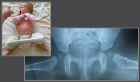 Рентген тазобедренных суставов ребенка в 6 месяцев, в положении с разведенными конечностями