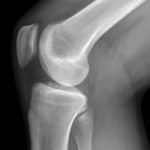 Рентгенограмма коленного сустава
