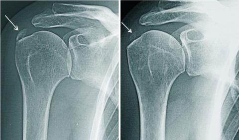 Рентгенограмма плечевого сустава с разрушением хряща