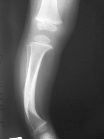 Рентгенограмма показывает формирование суставных поверхностей