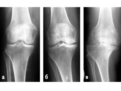 Рентгенограмма суставной щели в норме (а), в начальной стадии артроза (б), при коксартрозе (в)