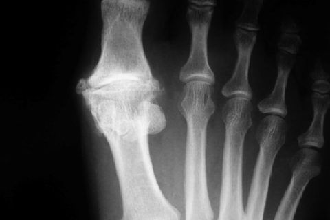 Рентгенологическая диагностика подагрического артрита
