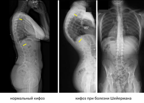 Рентгенологическая картина при болезни Шейермана-Мау