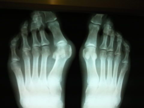 Рентгенологический снимок пальцев обеих ног.