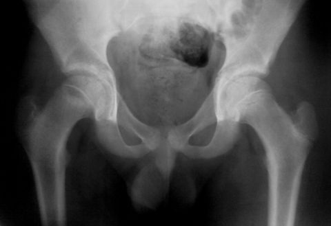 Рентгенологический снимок пациента с новообразованием в тазобедренном суставе.