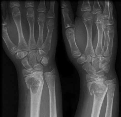 Рентгенологический снимок при исследовании лучезапястного сустава.