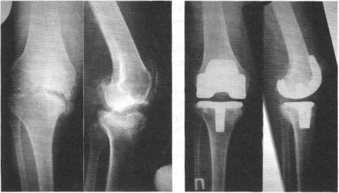 Рентгеновское обследование поможет судить врачу о причине сильной боли в колене у пациента.