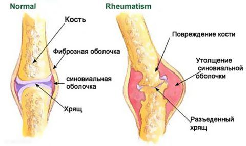 Ревматизм часто сопровождается ноющей болью в суставах.