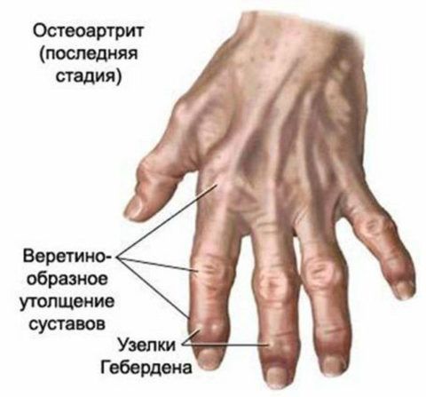 Руки пациента с артритом на крайней стадии заболевания.