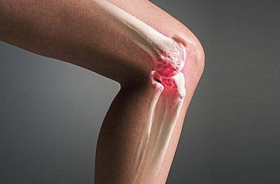 Щелкать колени могут при чрезмерной ежедневной нагрузке.