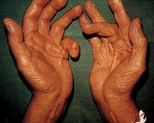 Скованность пальцев верхних конечностей приносит огромный дискомфорт больному.