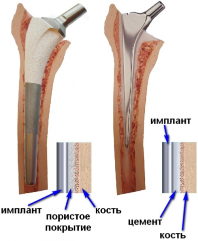 Слева – бесцементный способ фиксации протеза, справа – с использованием цемента