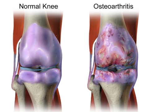 Слева – нормальное колено, справа – пораженное остеоартрозом