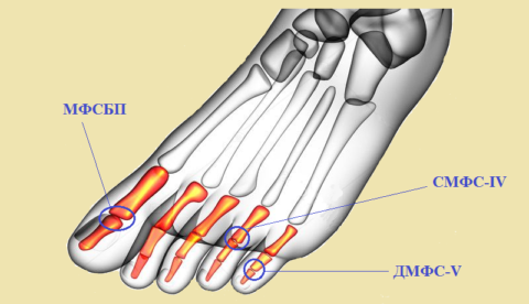 Соединения 13 фаланг пальцев нижней конечности (3 примера)