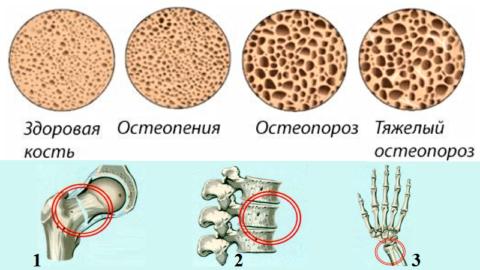 Стадии остеопороза и его «любимые» части человеческого скелета