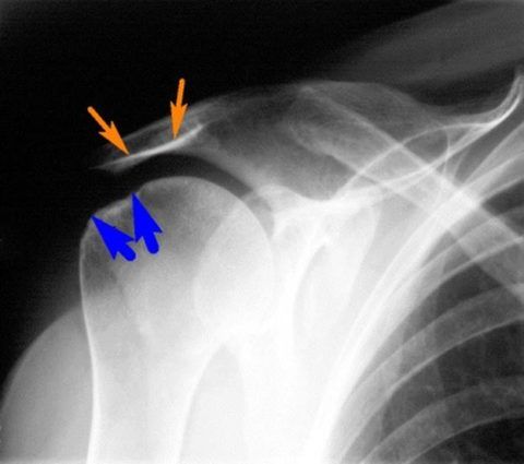 Субакромиальный бурсит плеча на рентгенограмме