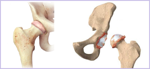 Тазобедренный сустав – здоровый и поражённый костными наростами
