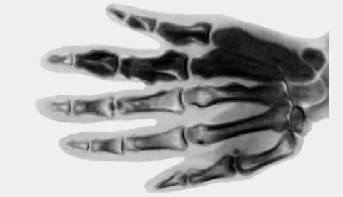 Тёмные кости на снимке – результат остеосклероза, увеличивающего плотность ткани