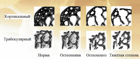 Типы структурных изменений и степень тяжести остеопорозного процесса