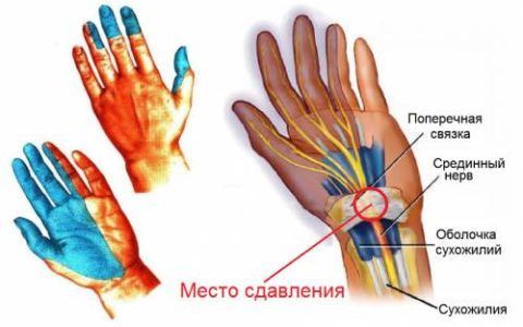 Туннельная нейропатия запястья – одна из частых причин болей в кисти рук по утрам