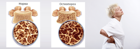 У 85% женщин за 50, в той или иной степени, но остеопороз тел позвонков уже есть