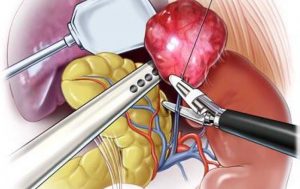 Феохромоцитома и артериальная гипертензия