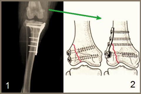 Варианты остеосинтеза верхнего сегмента большеберцовой кости (1) и наружного мыщелка бедренной кости (2)