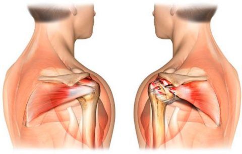 Вид нормального сухожилия (слева) вращательной манжеты и разорванного (справа)
