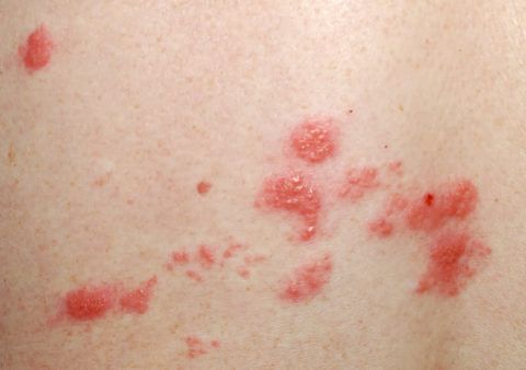 Вирус герпеса поражает нервные волокна и кожу