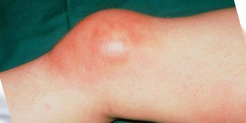 Воспаление синовиальных сумок в коленном суставе