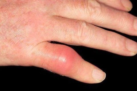 Воспаление суставной части пальца, увеличение в размере и гиперемия кожных покровов.