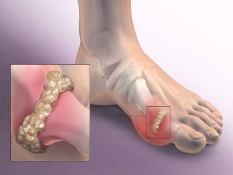 Воспалительный процесс между фалангами большого пальца левой ноги, характеризующийся болевым синдромом и тяжестью в осуществлении движений.