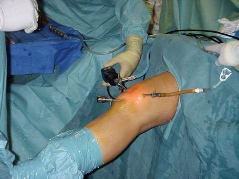 Введение артроскопа в колено с целью подачи лекарственного средства напрямую к суставной и хрящевой ткани мениска.