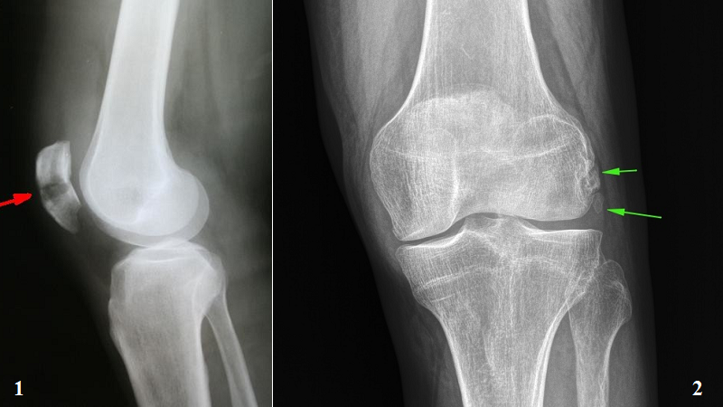 На рентгене: 1 – перелом надколенника; 2 – рассекающий остеохондрит (суставная мышь)