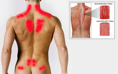 Области спины, наиболее подверженные мышечному напряжению и воспалению