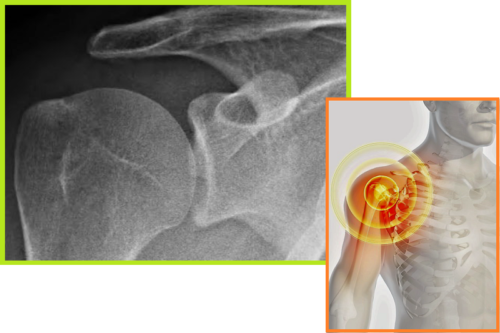 Строение плечевого сустава человека — рентгенография сочленения в норме