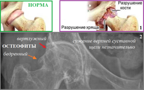 Коксартроз (1) и рентген остеофитов, вызывающие фемороацетабулярный синдром (2)