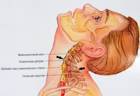 Защемляться могут нервы, сосуды, в тяжелых случаях спинной мозг